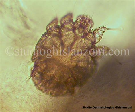 Microscopio che mostra acari della scabbia