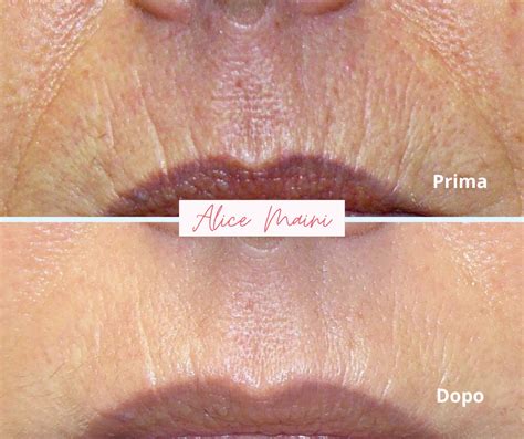 Rughe del codice a barre sul labbro superiore