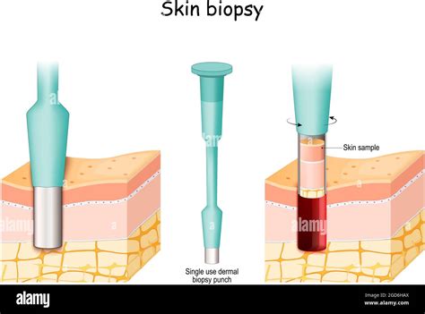 Schema illustrativo di una biopsia cutanea