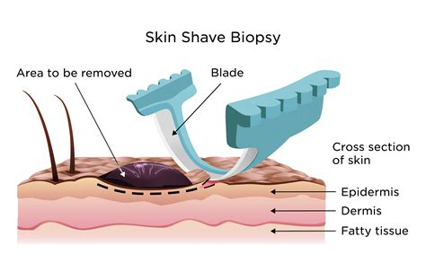 Illustrazione delle diverse tecniche di biopsia cutanea: shave, incisionale, escissionale, punch biopsy