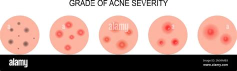 Diagramma che illustra le diverse tipologie e gradi di severità dell'acne