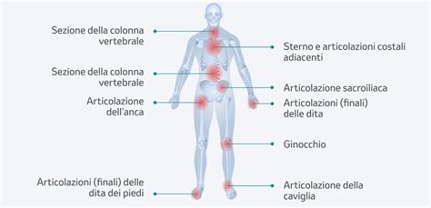 Schema anatomico delle articolazioni colpite da artrite psoriasica