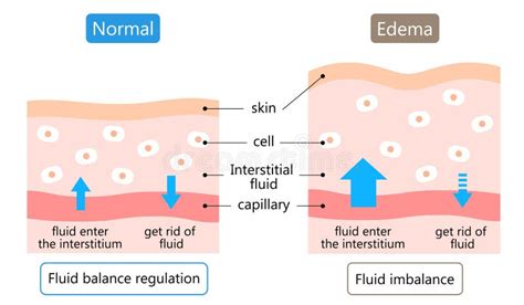 Diagramma che illustra l'accumulo di liquidi nei tessuti (edema)