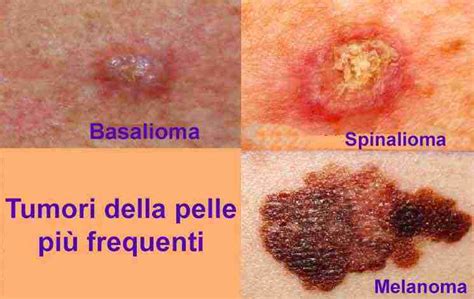 Diverse tipologie di basalioma