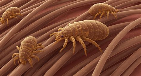 Illustrazione di pidocchi del capo sui capelli