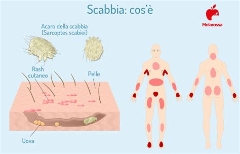 Illustrazione delle tipiche lesioni cutanee da scabbia, inclusi cunicoli e papule