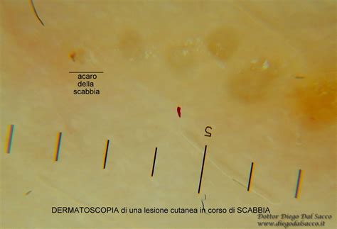 Immagine di un dermatoscopio utilizzato per la diagnosi della scabbia