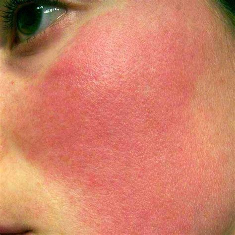 Viso con rossore diffuso e capillari visibili