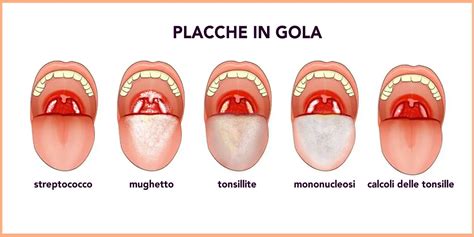 Illustrazione della lingua con placche bianche indicative di candidosi