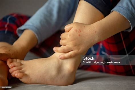 Bambino con eruzione cutanea della malattia mani-piedi-bocca