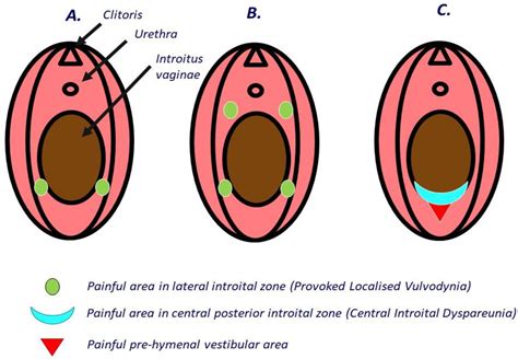 Illustrazione schematica della zona vulvare con enfasi sull'area soggetta a prurito