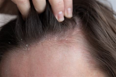 Immagine ravvicinata di pelle affetta da dermatite seborroica, mostrando rossore, squame e un aspetto oleoso