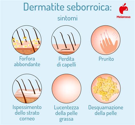 Infografica che illustra i diversi tipi di trattamenti per la dermatite seborroica: shampoo, creme, terapie sistemiche