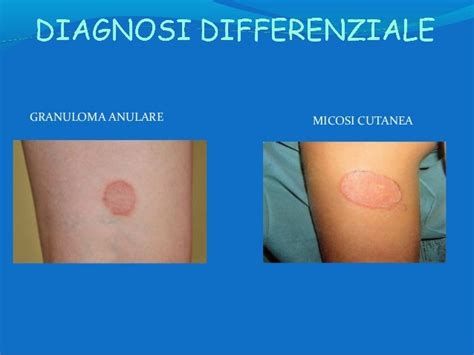 Illustrazione di lesioni cutanee ad anello