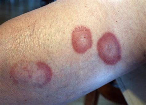 Confronto visivo tra eritema anulare centrifugo e granuloma anulare