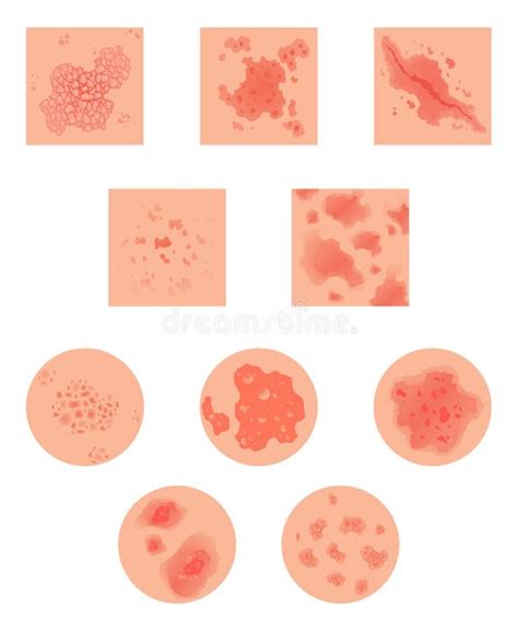 Illustrazione dei diversi sottotipi di psoriasi