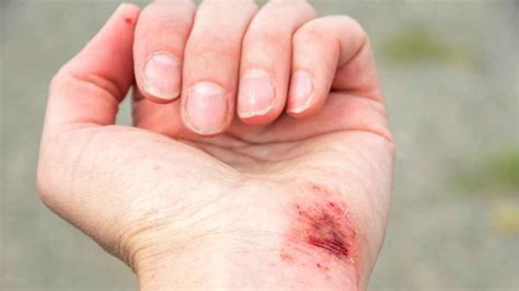 Illustrazione che mostra i segni di una ferita infetta: rossore, gonfiore, calore e pus