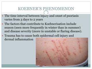Diagram illustrating the Koebner phenomenon in psoriasis