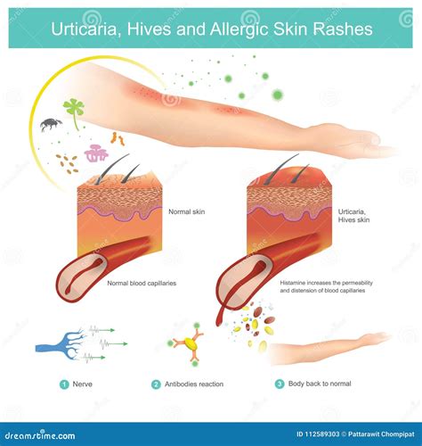 illustration of various skin rashes including urticaria, measles-like rash, and chilblains
