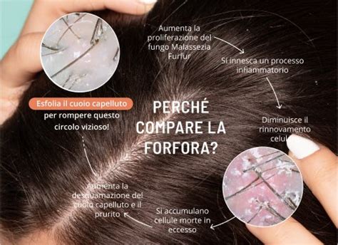 Schema delle cause della forfora