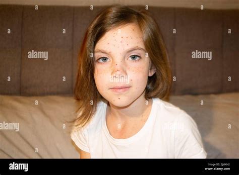 Bambino con macchie di varicella