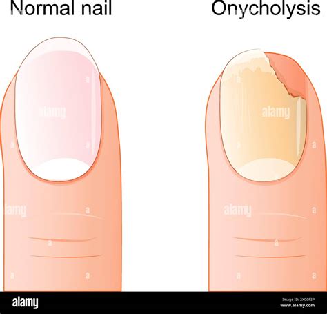 Unghia del piede sana vs unghia del piede con onicomicosi