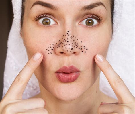 Primo piano di un naso con visibili punti neri