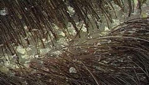 Immagine ravvicinata di un cuoio capelluto con forfora e desquamazione