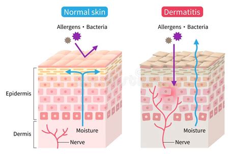 Illustrazione microscopica di cellule cutanee con segni di atrofia e infiammazione.