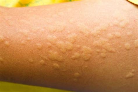 Bambino con eruzione cutanea da orticaria