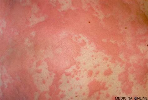 Diagramma che illustra la differenza tra orticaria acuta e cronica