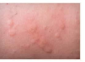 Immagine ravvicinata di pomfi di orticaria su pelle infantile