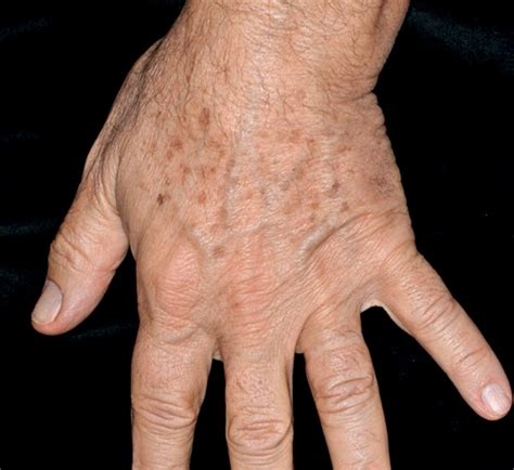 Immagine di lentigo solari sul dorso delle mani