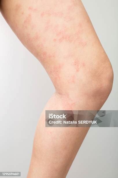 Pelle infiammata con eritema e piccole vescicole