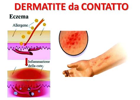 Mano con eczema da contatto e eritema diffuso