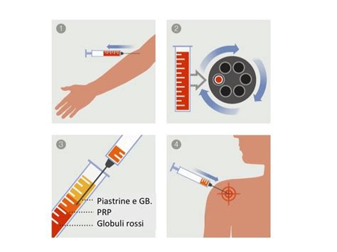 Schema di preparazione del PRP
