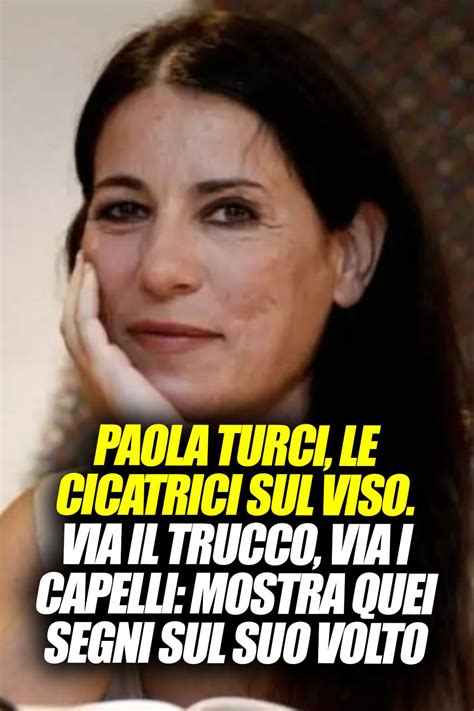 Paola Turci con cicatrici sul viso