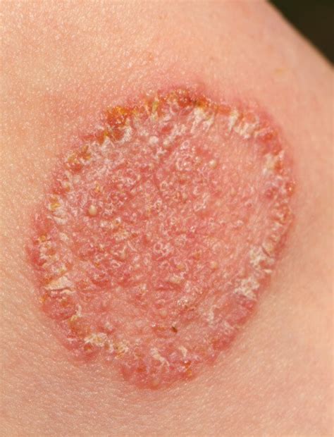 Immagine che mostra diverse manifestazioni cutanee di micosi, tra cui macchie ad anello, desquamazione e vescicole