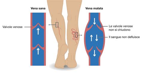 Diagramma anatomico delle vene delle gambe con valvole venose