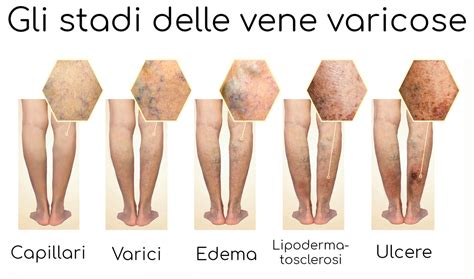 Immagine che mostra la differenza tra gambe sane e gambe con vene varicose evidenti