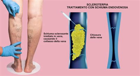 Infografica sui diversi trattamenti per le vene varicose: scleroterapia, laser, chirurgia