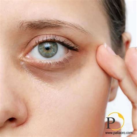 Infografica che confronta diversi trattamenti per le occhiaie