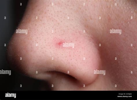 Primo piano di un naso con un piccolo brufolo