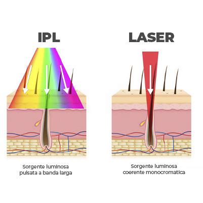 Schema comparativo tra Laser e Luce Pulsata