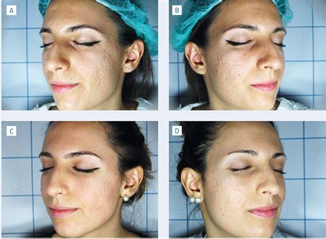 Schema che illustra il funzionamento del laser nel trattamento delle cicatrici