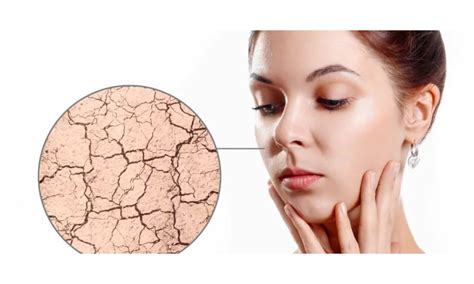 Pelle secca con applicazione di crema