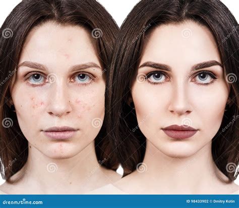 pelle con acne prima e dopo il trucco correttivo