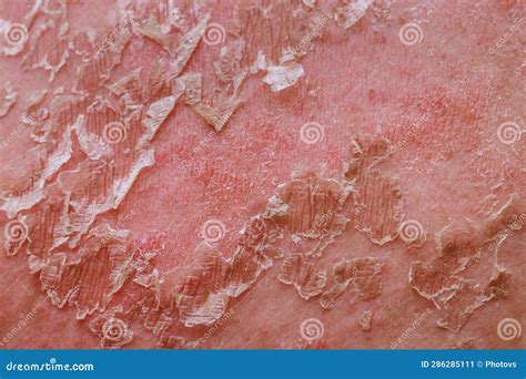 Illustrazione stilizzata di una pelle irritata con rossore e prurito