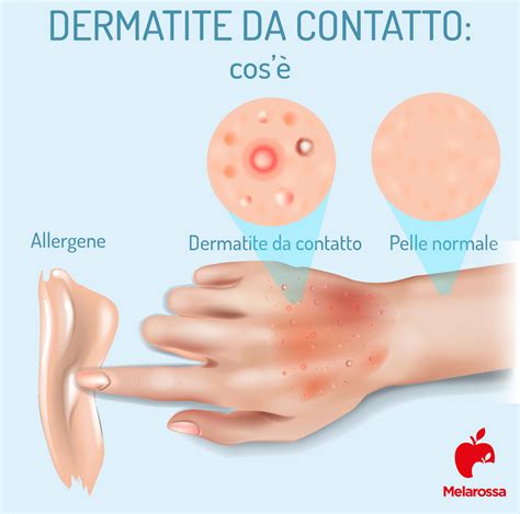 Schema che illustra le zone comuni di dermatite da contatto (mani, viso, collo)