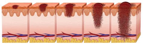 Diagramma che confronta la crescita radiale del melanoma a diffusione superficiale con la crescita verticale del melanoma nodulare